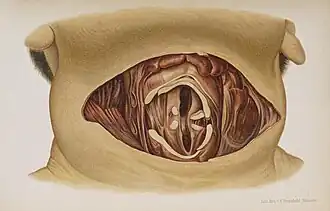 Eduard Ritter von Hofmann (1837-1897): "Lehrbuch der gerichtlichen Medicin." Vienna, 1878. / taken from translation "Atlas of Legal Medicine", Philadelphia 1898. Plate 16: Suicide by cutting the throat. Death through suffocation.
