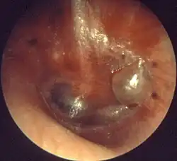 An inflamed Otitis Media.