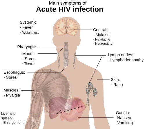 Symptoms of HIV infection