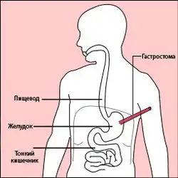 Гастростомия26 апреля 2012