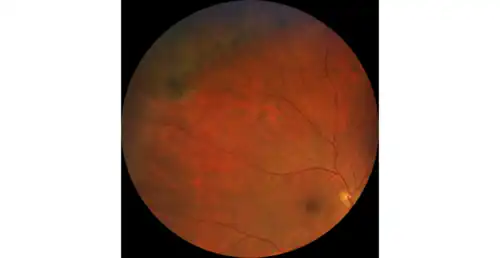 Решётчатая дистрофия