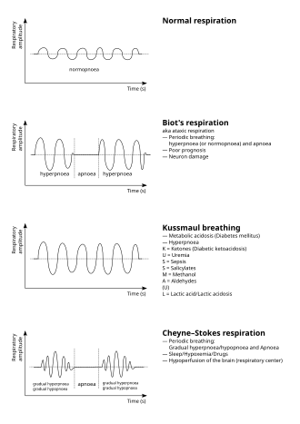 Графическое изображение периодического дыхания