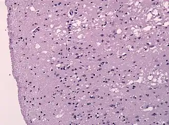 Гистологический препарат — ткань лобной доли головного мозга больного болезнью Крейтцфельдта — Якоба