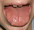 Нейрофибромы края языка 23-летней пациентки с синдромом МЭН типа IIb