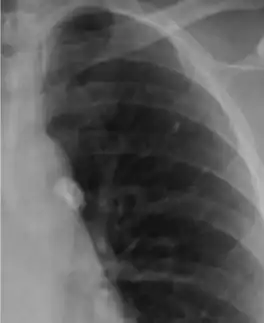 Рентген грудной клетки со следами очага Гона