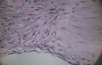 Разрыв десцеметовой оболочки при кератоконусе.