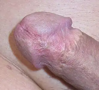 Шрам после обрезания