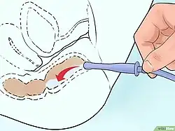 Вставка наконечника клизмы в прямую кишку, начинающая проникать в анальный сфинктер