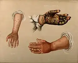 Последствия чесотки