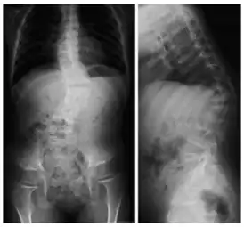 Рентгеновский снимок позвоночника пациента с кифосколиозом. На проекциях хорошо видно искривление позвоночного столба вбок (сколиоз) и выпуклостью назад (увеличенный кифоз)