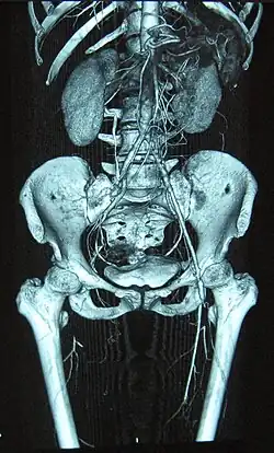 Полная окклюзия правой и стеноз левой бедренной артерии при облитерирующем тромбоангиите