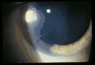 Видны нервные волокна роговицы у 27-летней пациентки с синдромом МЭН типа IIb