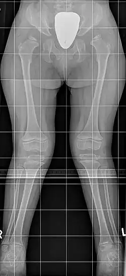 Синдром Моркио: на рентгенограмме с двух сторон отмечается укорочение шейки бедра, в результате чего уменьшается поперечник таза; крылья подвздошных костей неправильной формы; характерна вальгусная деформация нижних конечностей