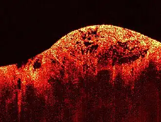 Изображение саркомы сделано с помощью оптической когерентной томографии (ОКТ)