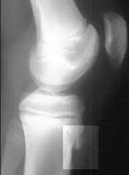 Рентгенограмма коленного сустава в боковой проекции, демонстрирующая фрагментацию большеберцовой бугристости с отёком окружающих мягких тканей. Разрушение костной ткани.