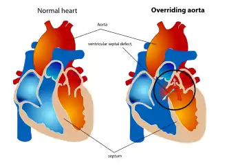 Диаграмма здорового сердца и сердца с тетрадой Фалло, обведена декстрапозиция аорты