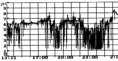 24-х часовая pH-метрия пищевода (фрагмент pH-граммы больного ГЭРБ)
