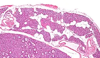 Микропрепарат: Паращитовидная железа — слева внизу аденома паращитовидной железы.