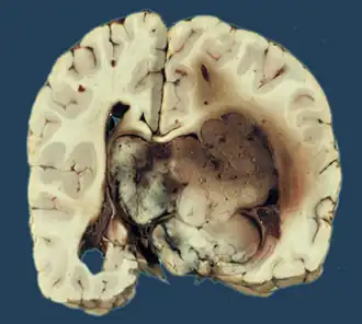 Хориоид­папиллома11 июня 2012