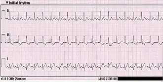 ЭКГ с синусовой тахикардией. ЧСС около 150.