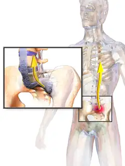 Ankylosing spondylitis.