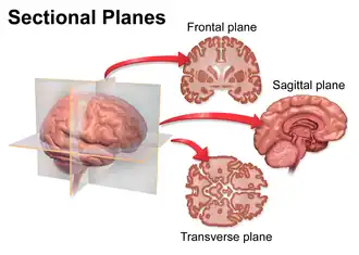 Anatomical planes of the brain.