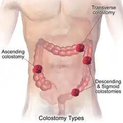 Types of colostomy.