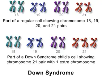 Karyotyoe in Down syndrome.