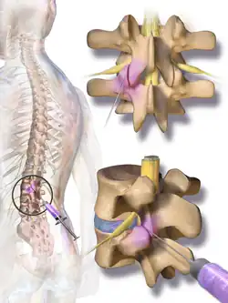 Facet joint injection.