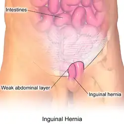 Inguinal hernia.