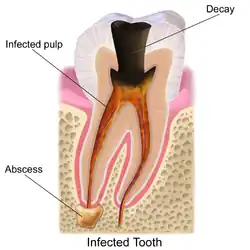 Tooth decay.